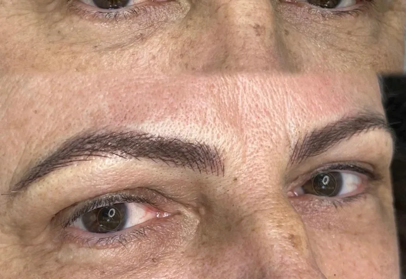 Antes e depois de correção de micropigmentação com remoção a laser